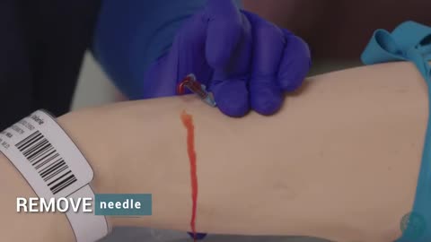 Iv cannulation technique