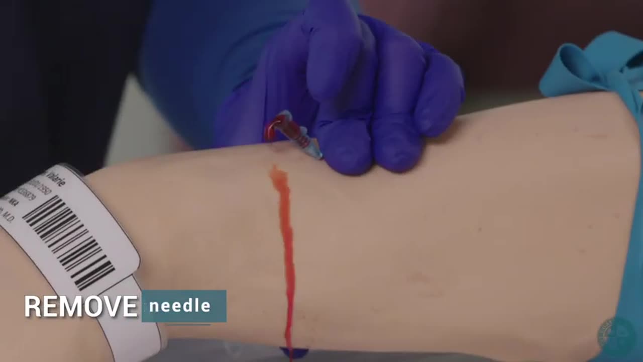 Iv cannulation technique