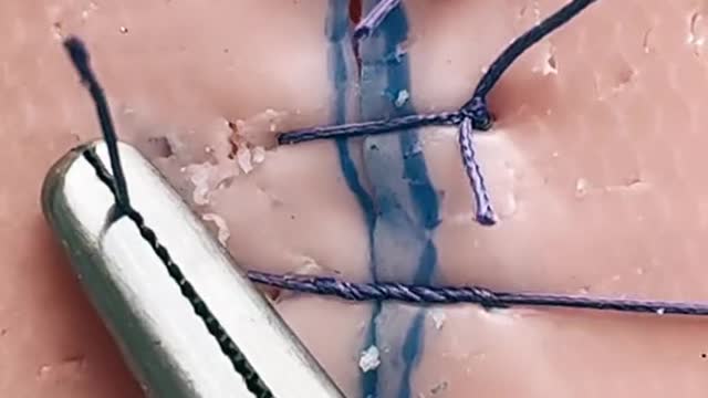 Simple interrupted suture