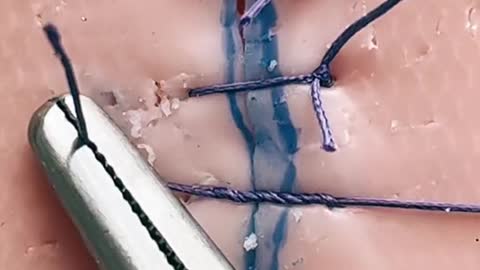 Simple interrupted suture