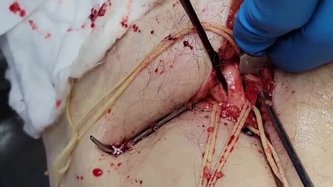 Vaccines cause blood clot