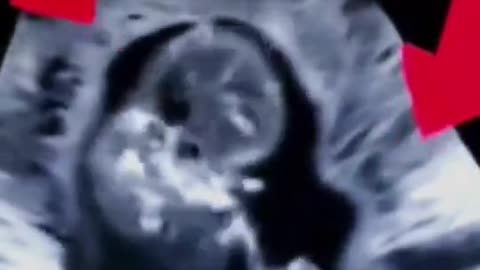 This Ultrasound of a Baby Struggling in Agony to Resist the Pincers of an Abortionist is Perhaps