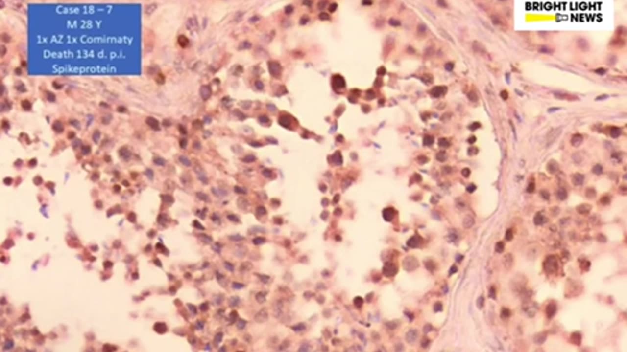 Pathologist Arne Burkhardt, studying mRNA spike proteins being expressed in testes.