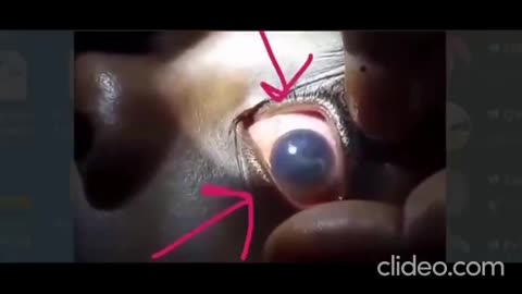 FREAK OUT ALERT !! DR. RECORDS HYDRA VULGARIS SWIMMING IN THE EYE OF AN 11YR OLD VAXXED PATIENT !!