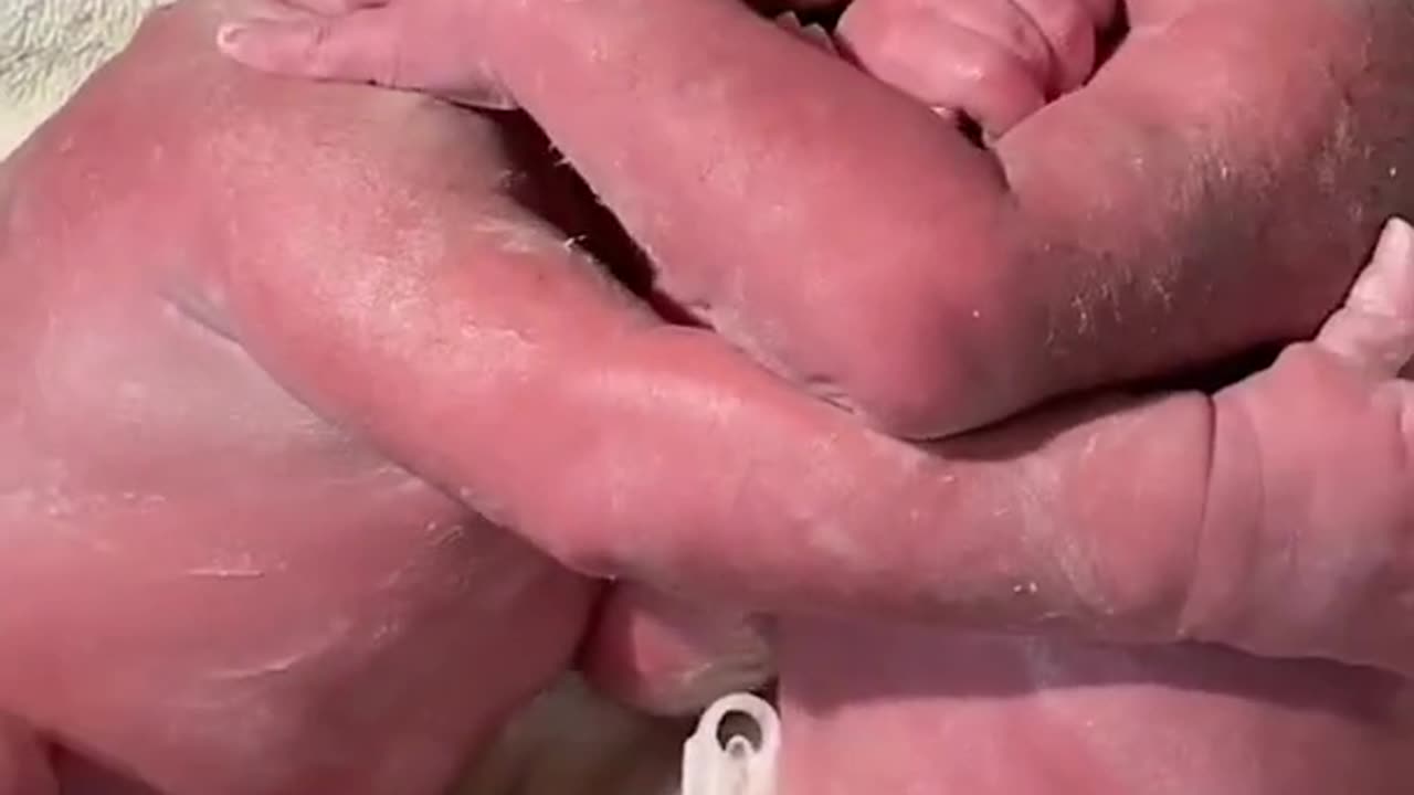 Twin birth 😍😍