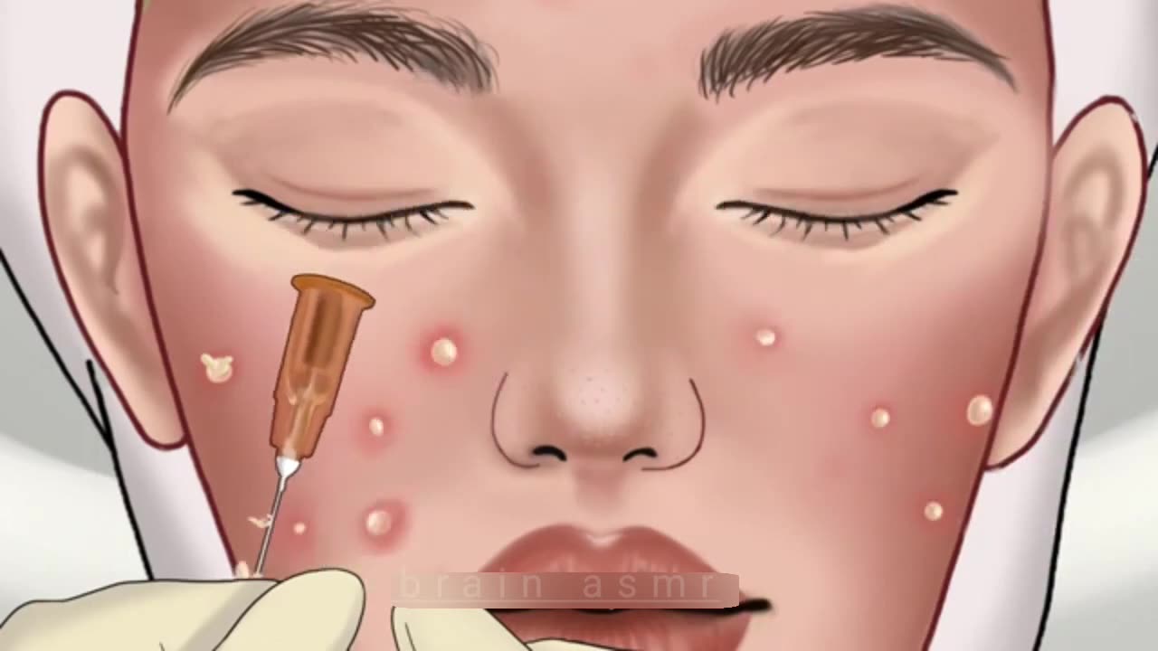 ASMR Treatment of blackheads and hidden acne processing | @SatisfyingASMRanimation