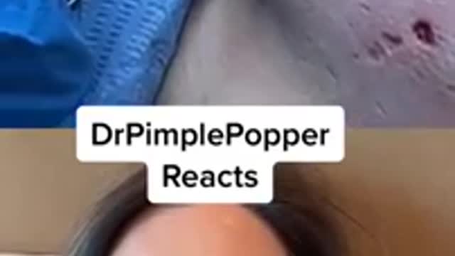 I'm not sure what she's doing! Dr Pimple Popper Reacts to Cyst Removal