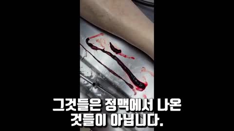 접종자시신 장골동맥혈전