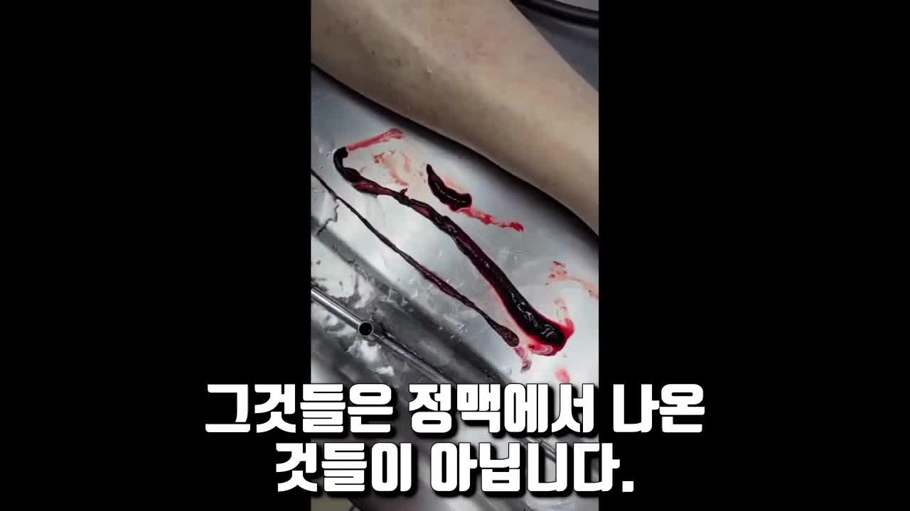 접종자시신 장골동맥혈전