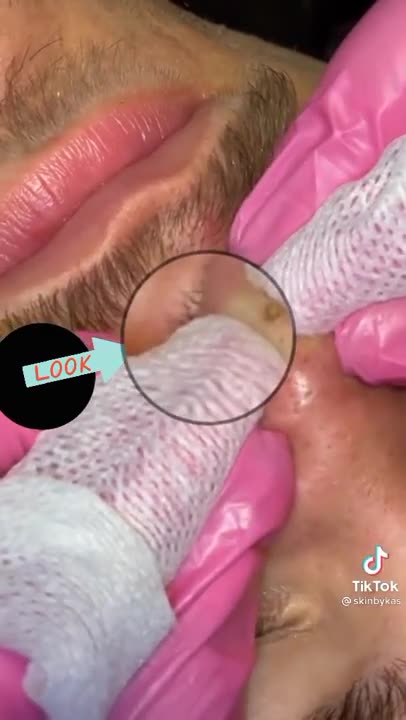 Pimple Popping _ Acne Treatment _ Blackhead Extraction