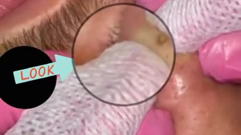 Pimple Popping _ Acne Treatment _ Blackhead Extraction