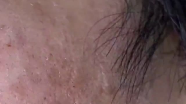 Giants Deep Blackheads, Whiteheads, Big Pimples, Hidden Acne Removal - Best Popping Videos #000023