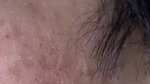 Giants Deep Blackheads, Whiteheads, Big Pimples, Hidden Acne Removal - Best Popping Videos #000023