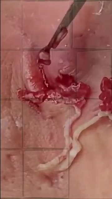 dr pimple popper drpimplepopper pimple