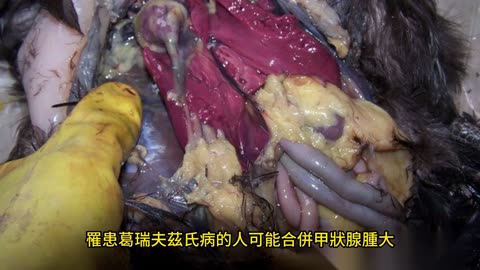 莫名暴瘦 甲狀腺亢進