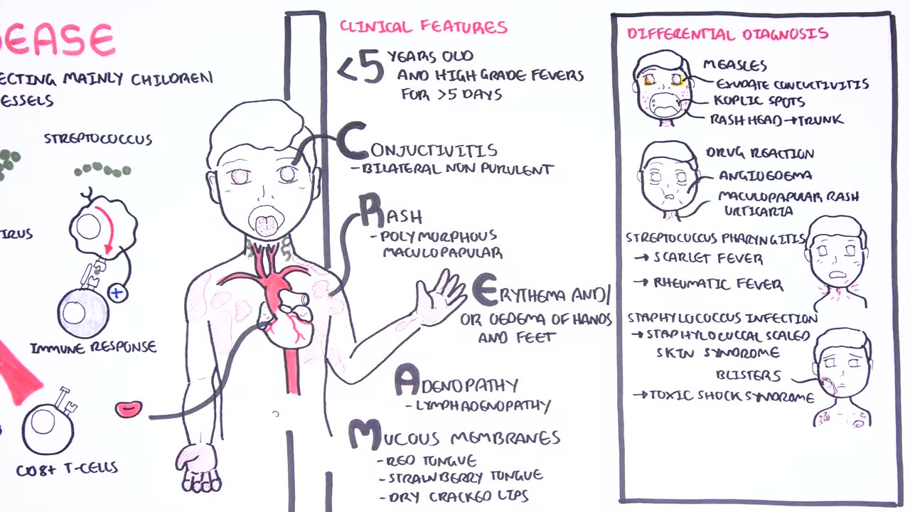 Kawasaki Diseas Vasculitis