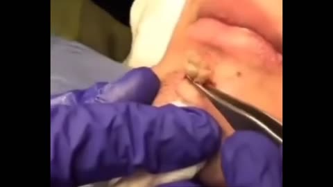 MASSIVE BLACKHEAD Extraction on Man's Chin!!!!