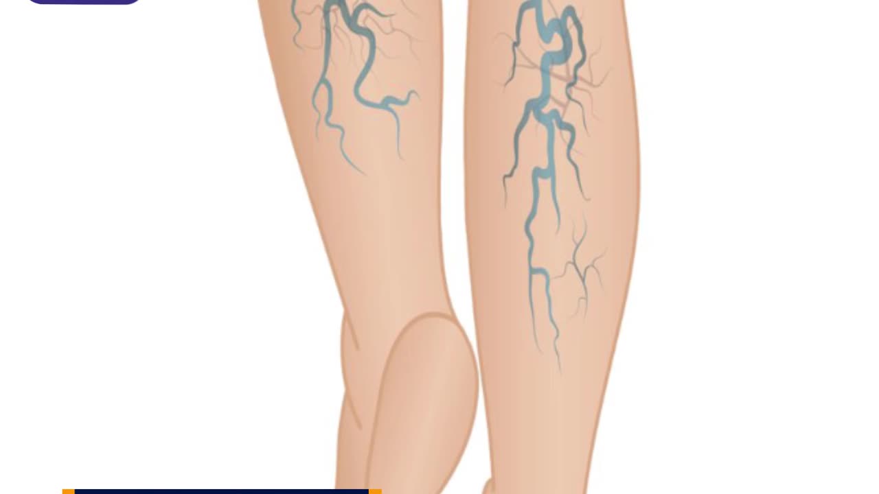 Homeopathic Medicine & Treatments for Varicose Veins