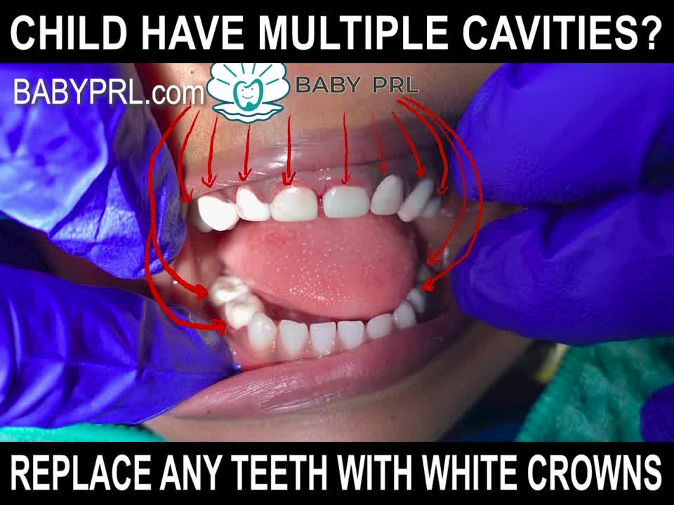 Alternatives To Silver Crowns For Baby Teeth Cavities