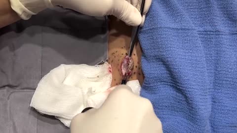 ＂It's Like a Cement Truck＂ - Dr Pimple Popper Removes The Cement Cyst