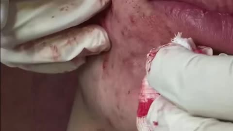 SEVERE ACNE REMOVAL INFECTED BLACKHEADS