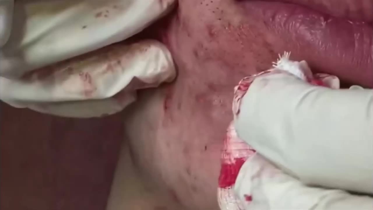 SEVERE ACNE REMOVAL INFECTED BLACKHEADS