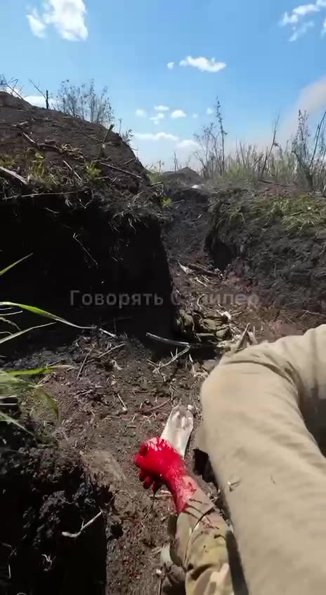 Ukrainian Takes a Bullet to the Arm(Incredible)