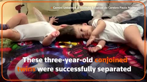 Conjoined twins successfully separated in Brazil - Science