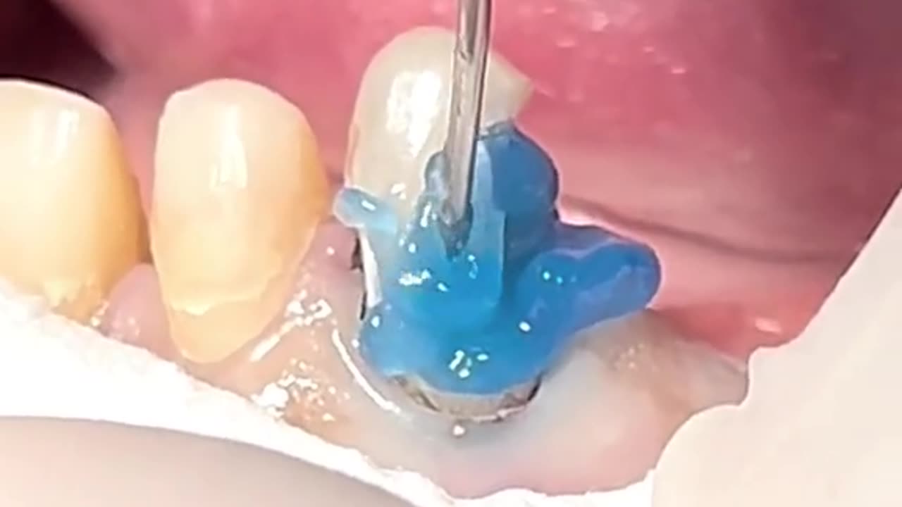 Fiber post #dentist #dental #teeth #tartar #calculus #dentista