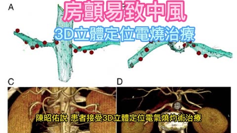 房顫易致中風 3D立體定位電燒治療
