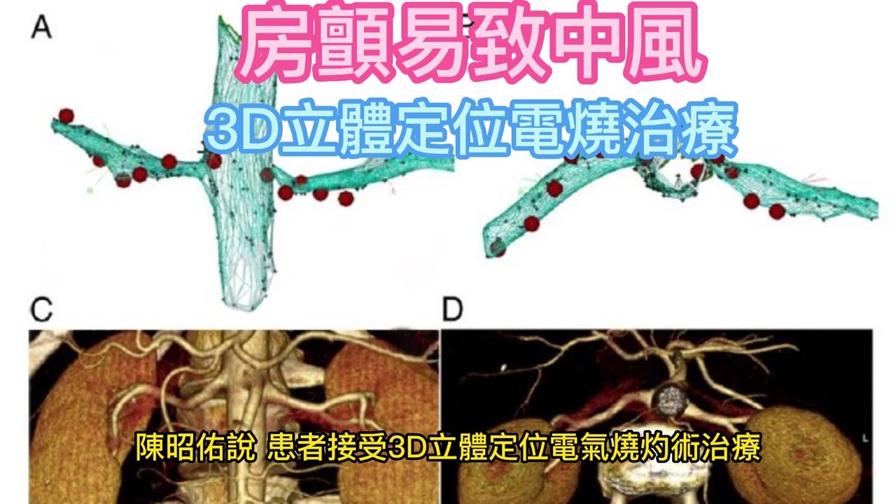 房顫易致中風 3D立體定位電燒治療