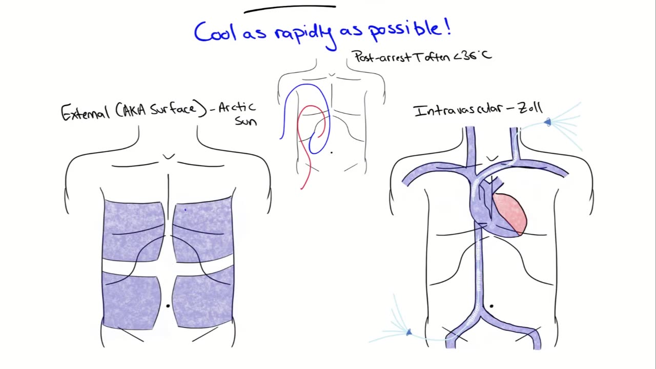 Targeted Temperature Management