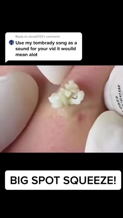 Blackheads Popping & Blackhead Removal Videos 2022