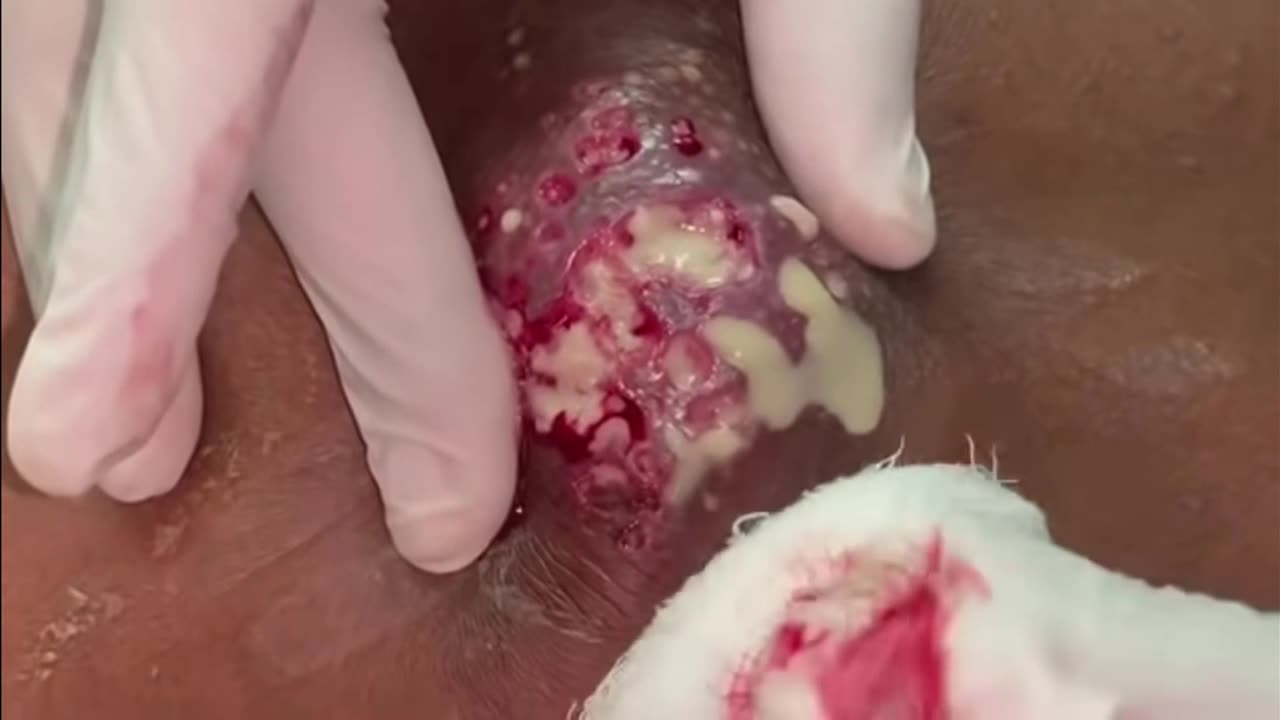 HUGE CARBUNCLE PUSTULE WHITEHEAD FILLED CYSTS DRAINAGE