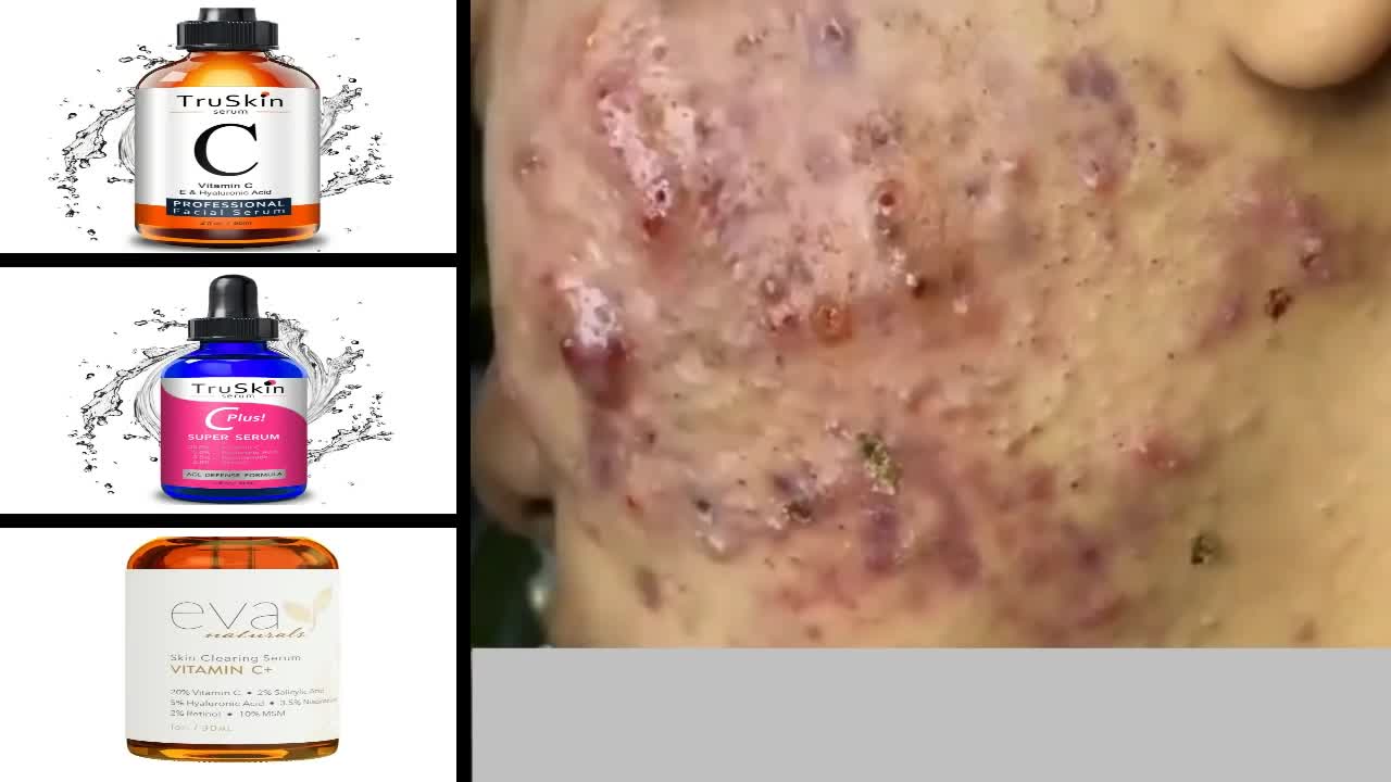 Blackheads Removal & Pimple Popping Videos