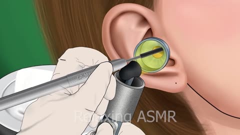 ASMR The best treatment and remove flies and slimes in girls' ears