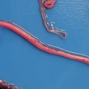 Richard Hirschman Fiberous clots of the vaccinated