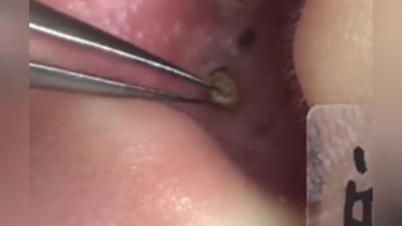 That Blackhead Is So Huge! So Satisfying to Watch!