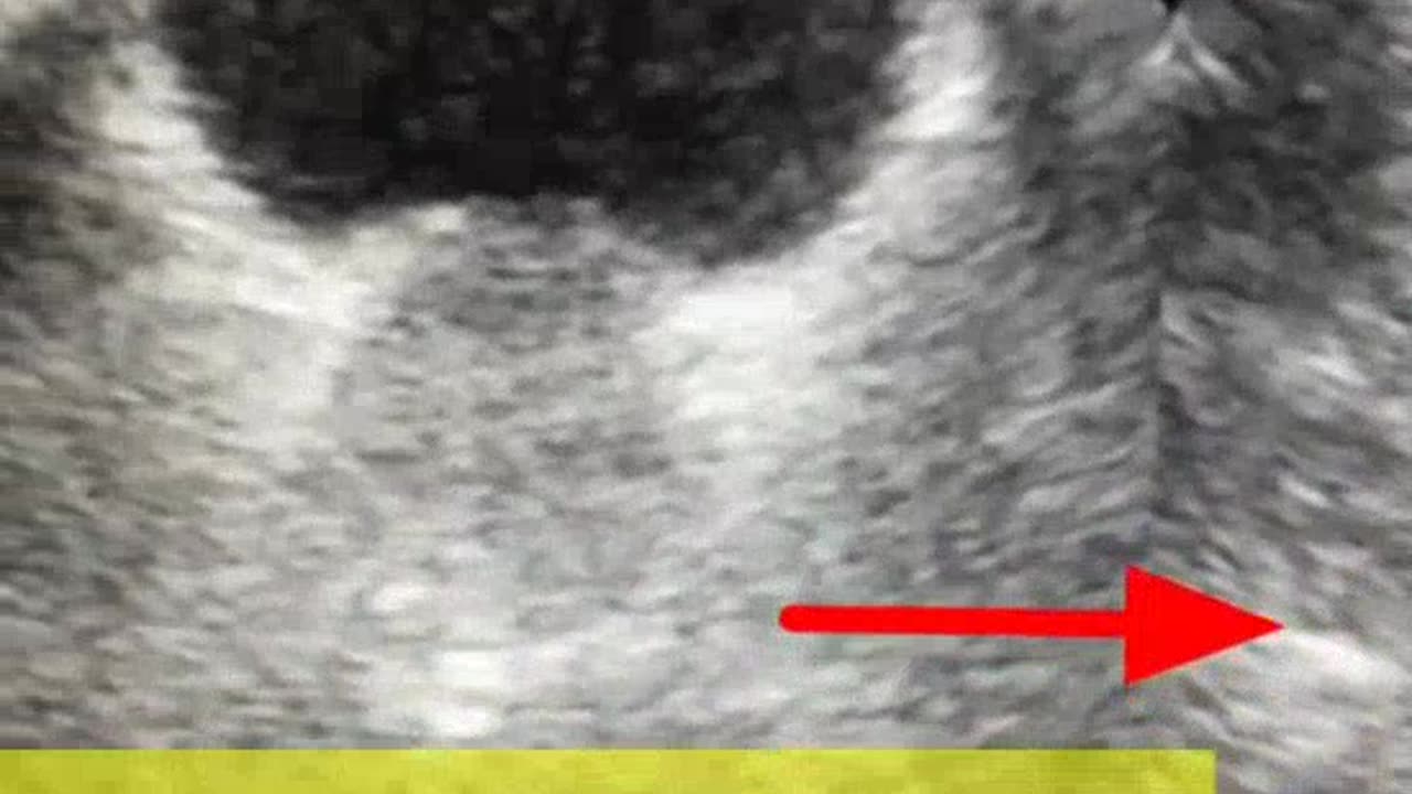BPH l Seminal V cyst l CA prostate l 4