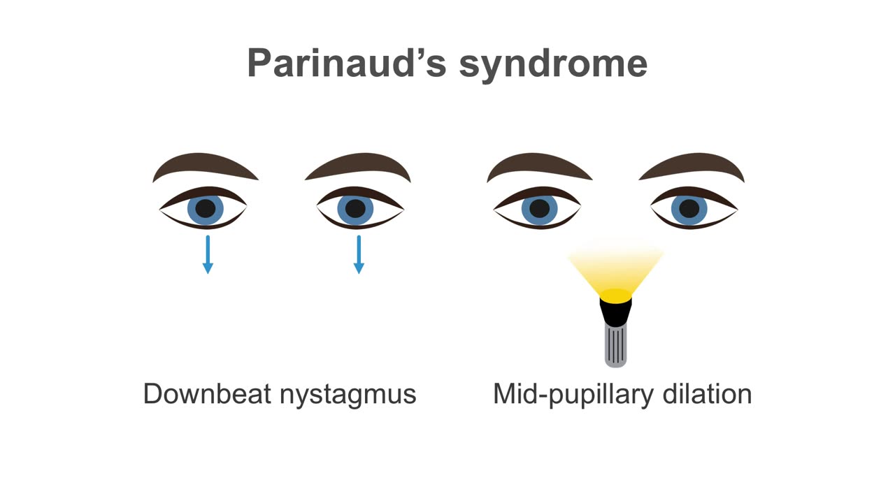 Clinical Neurology Essentials 3.Revealing the mysteries of the midbrain