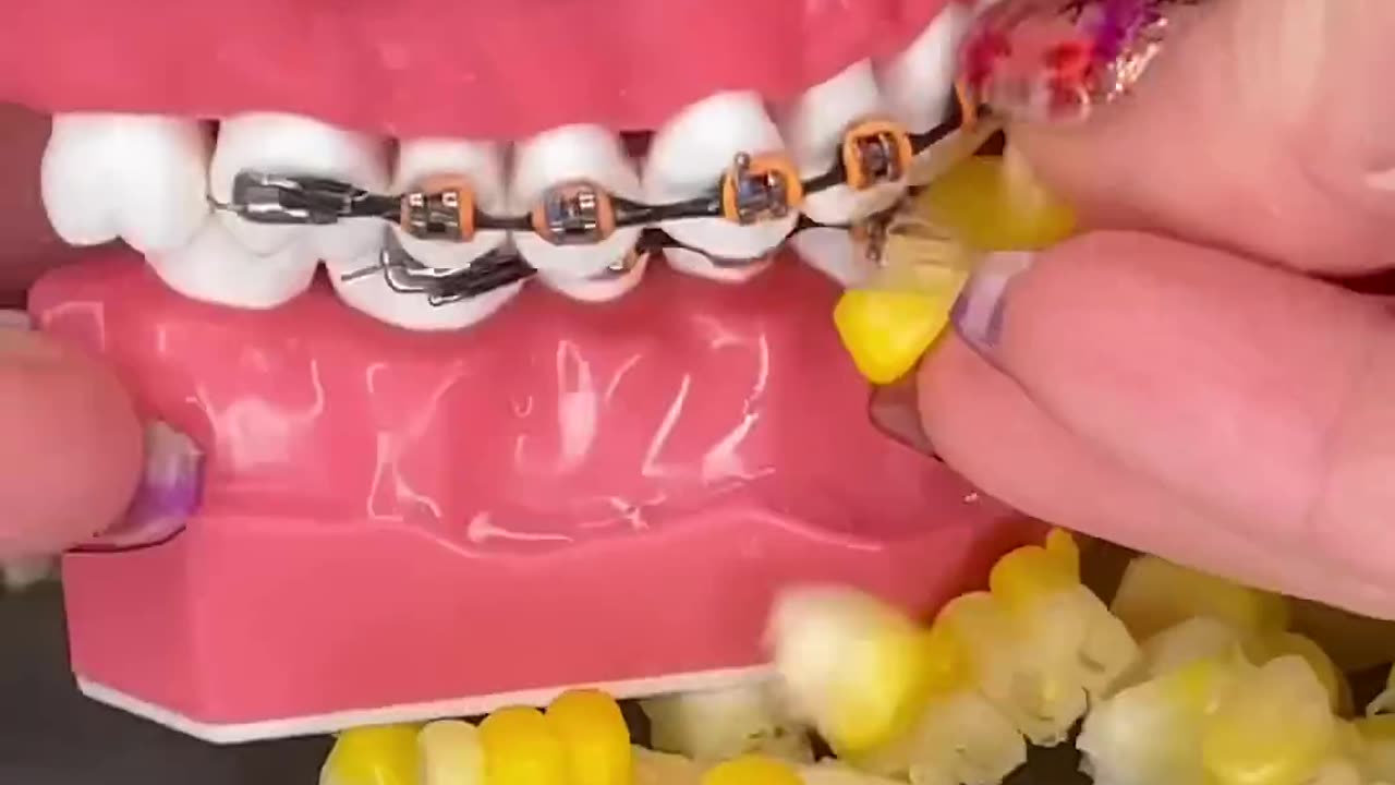 3 BARBECUE foods to AVOID with BRACES! what to eat instead ?