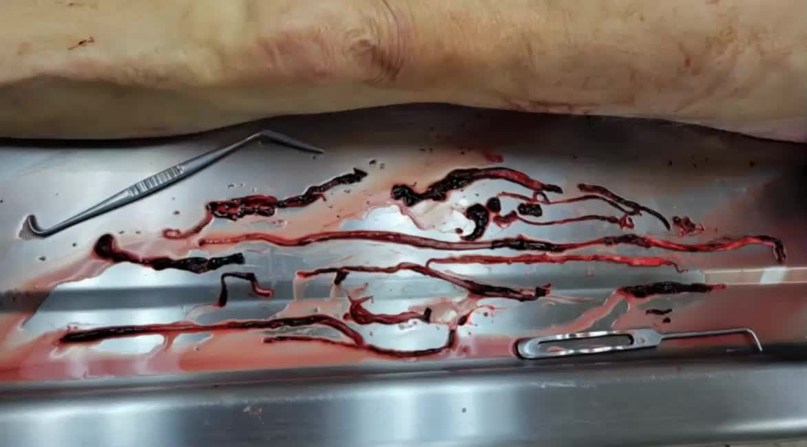 COVID Vax Clot Death
