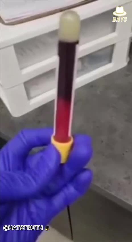 Vaxxed 🅰️🅱️🆎🅾️🩸Blood