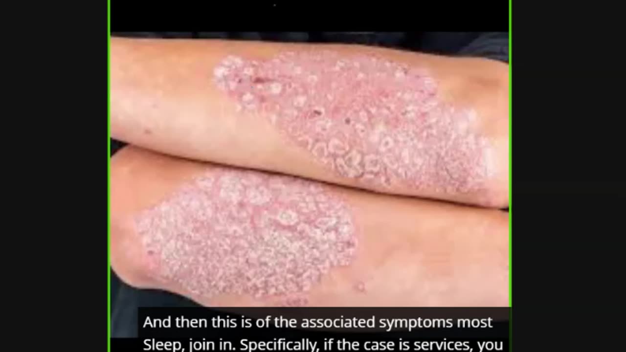 ST5.55 year man with skin rash