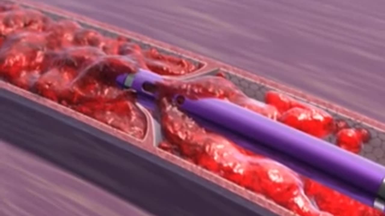 DVT Treatment to Remove the Clot | Vein Artery Specialist