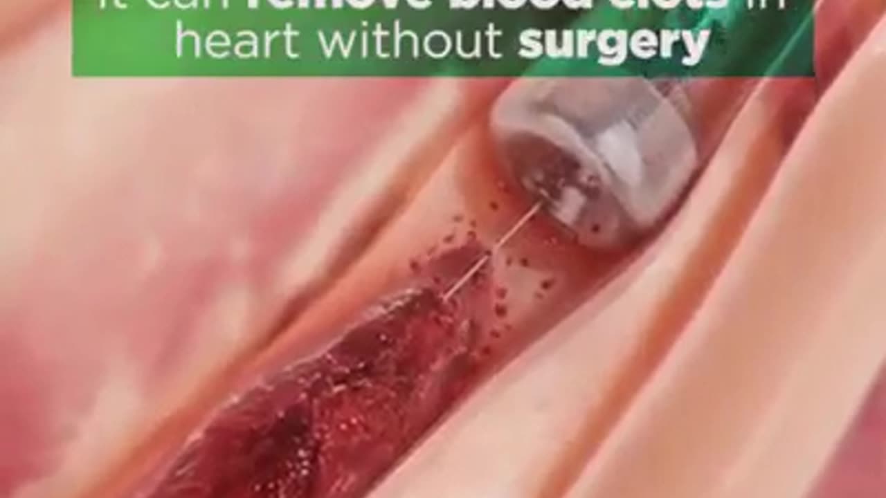 Removing blood clots within surgery now possible…