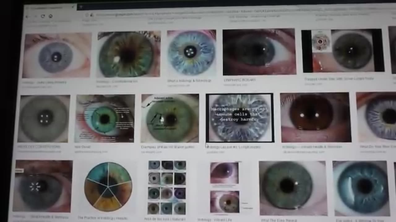 EBV & Iridology Information (This is an older video from 2018)