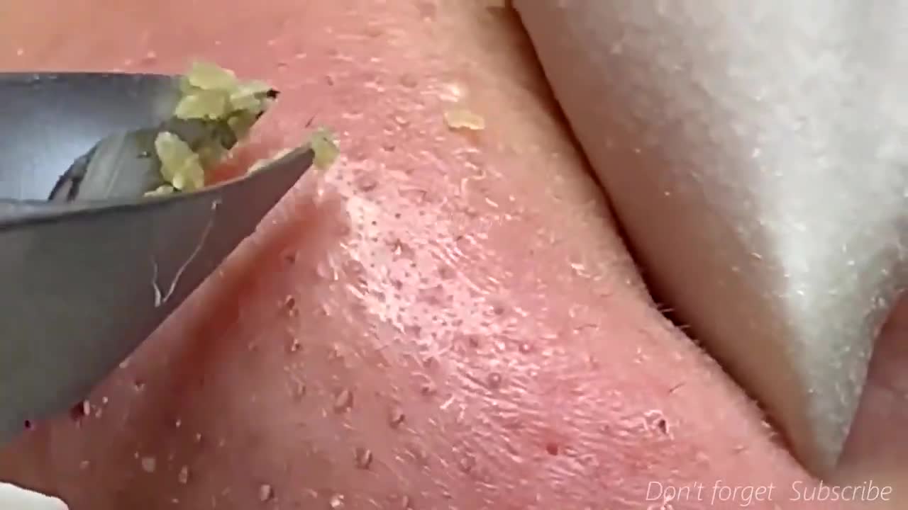 Massive BlackHeads Removal.!!!