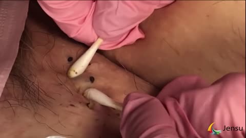 blackheads removal