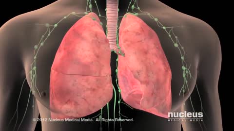Avoiding Lung Cancer